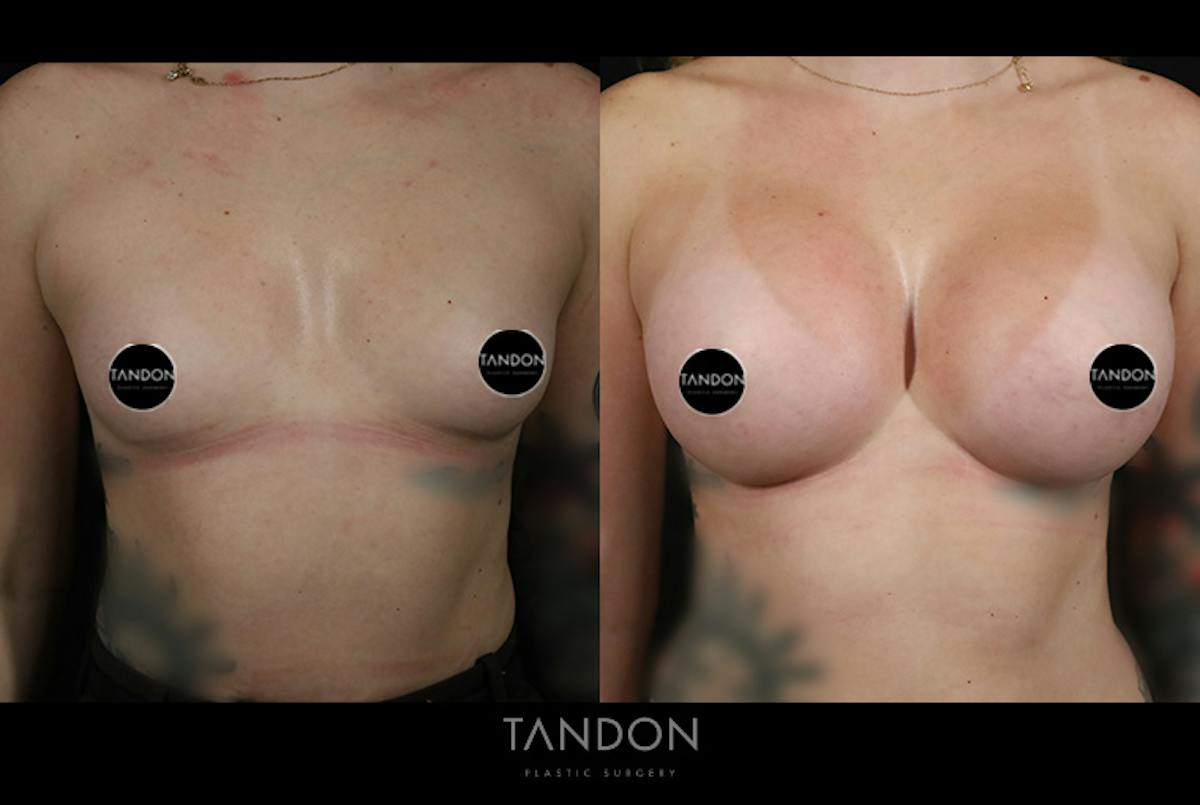 Breast Augmentation  Before & After Gallery - Patient 336505 - Image 1