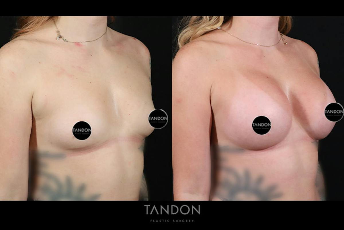 Breast Augmentation  Before & After Gallery - Patient 336505 - Image 2
