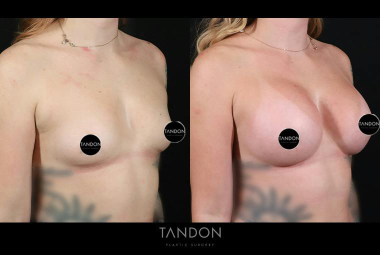 Breast Augmentation Before & After Gallery - Patient 336505 - Image 2