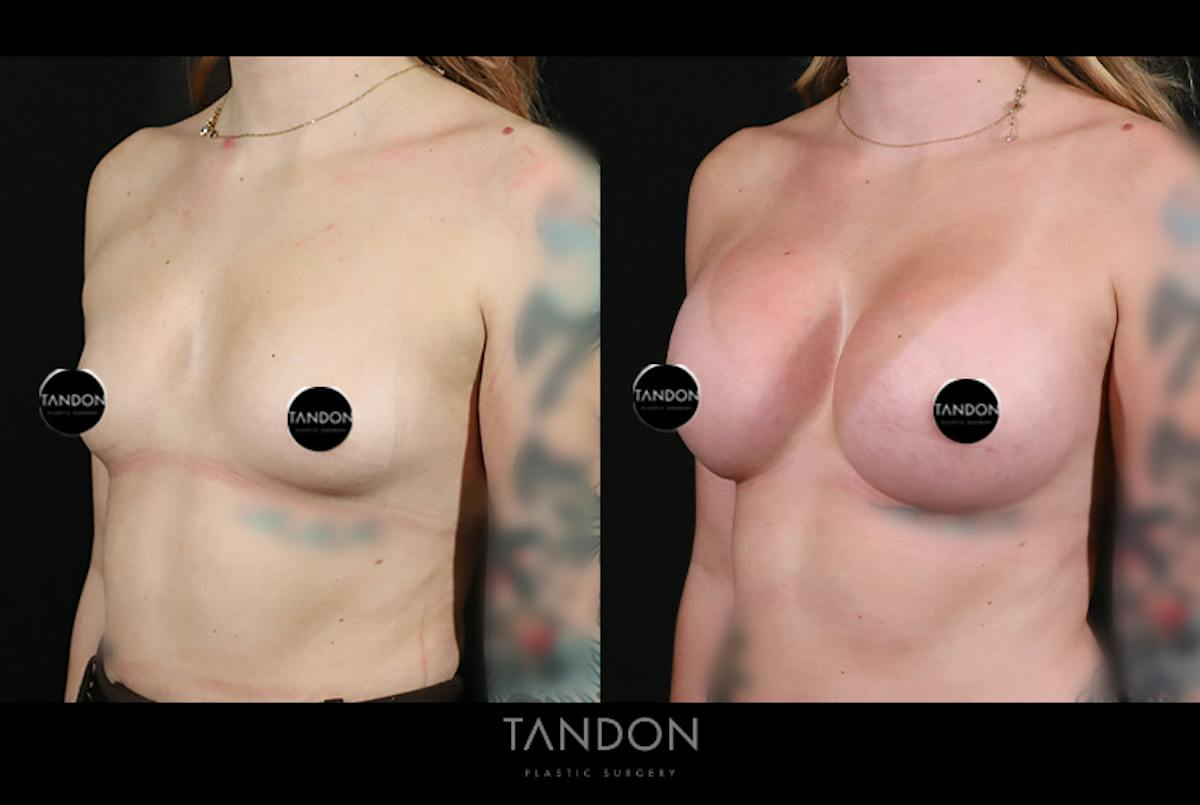 Breast Augmentation  Before & After Gallery - Patient 336505 - Image 3