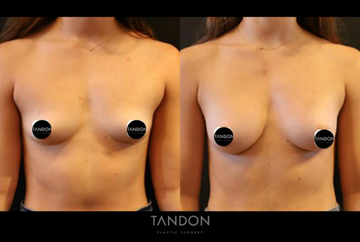 Breast Augmentation  Before & After Gallery - Patient 205273 - Image 1