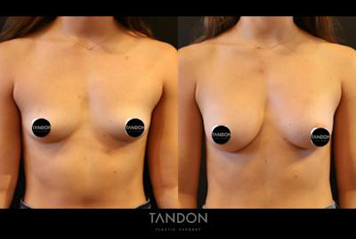 Preservé by Motiva Breast Augmentation Before & After Gallery - Patient 389073 - Image 1