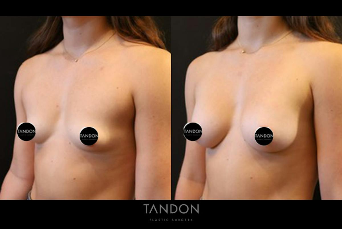 Breast Augmentation  Before & After Gallery - Patient 205273 - Image 3