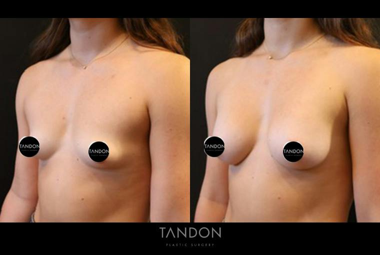 Breast Augmentation Before & After Gallery - Patient 205273 - Image 3
