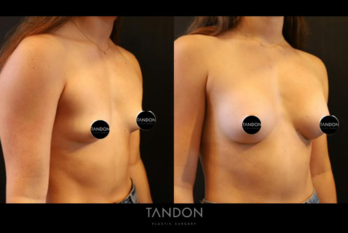 Breast Augmentation  Before & After Gallery - Patient 205273 - Image 2