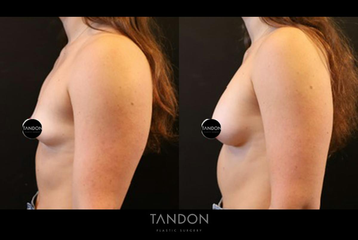 Breast Augmentation  Before & After Gallery - Patient 205273 - Image 4