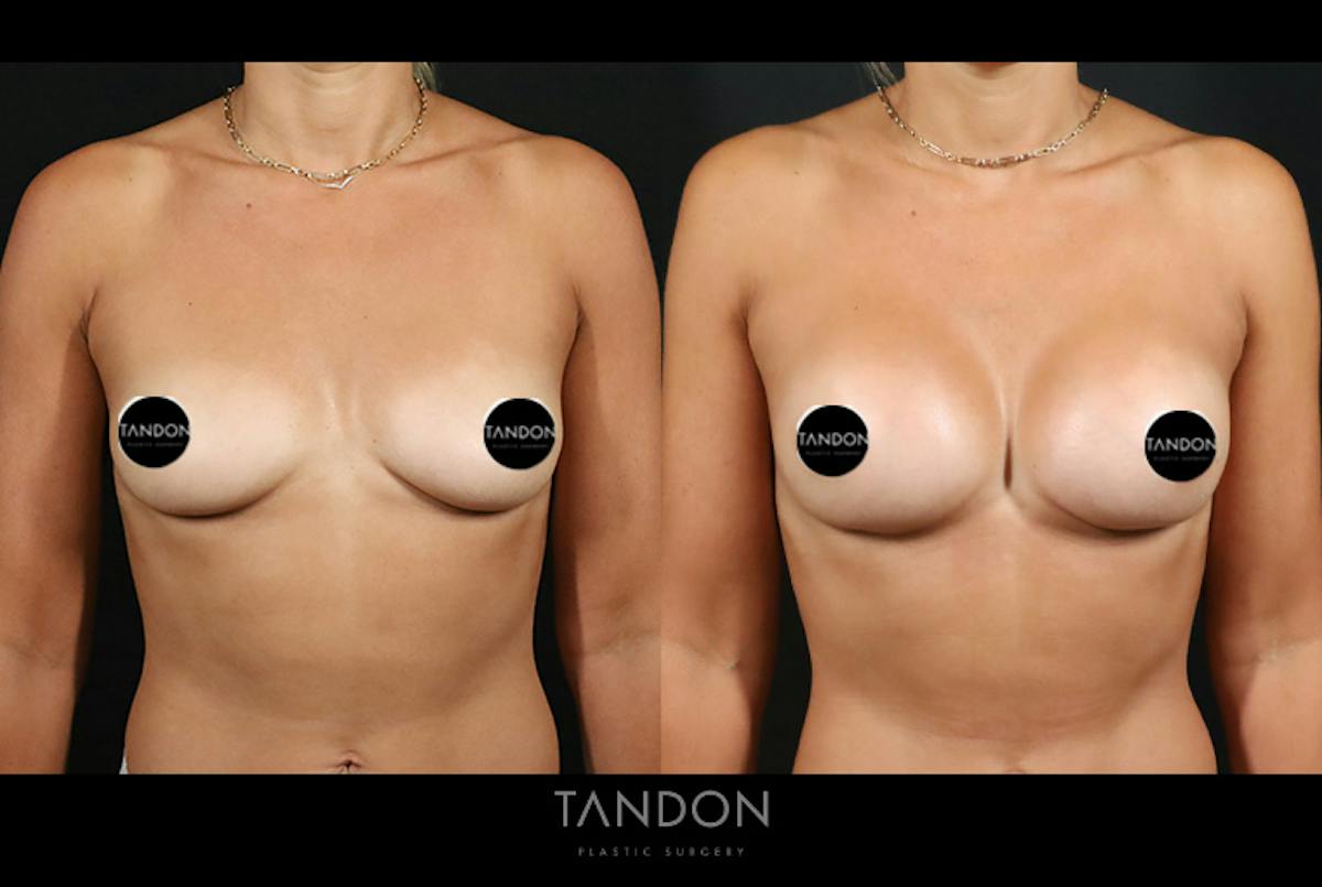 Preservé by Motiva Breast Augmentation Before & After Gallery - Patient 131882 - Image 1