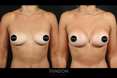 Preservé by Motiva Breast Augmentation Before & After Gallery - Patient 131882 - Image 1
