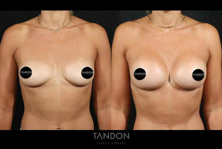 Preservé by Motiva Breast Augmentation Before & After Gallery - Patient 131882 - Image 1