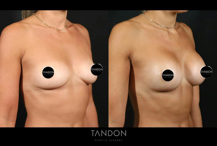 Preservé by Motiva Breast Augmentation Before & After Gallery - Patient 131882 - Image 2