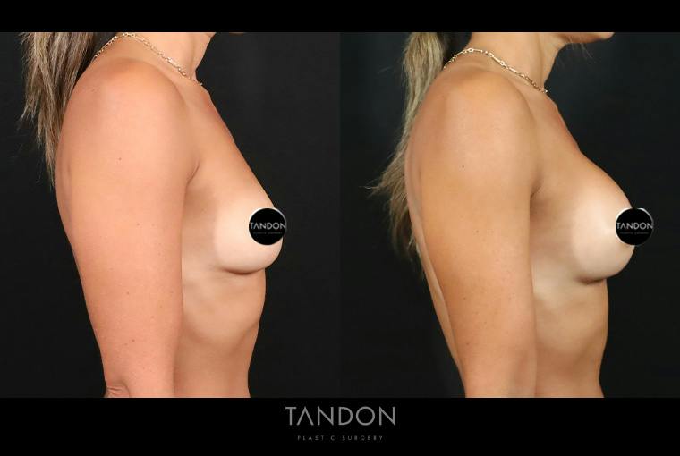 Preservé by Motiva Breast Augmentation Before & After Gallery - Patient 131882 - Image 3