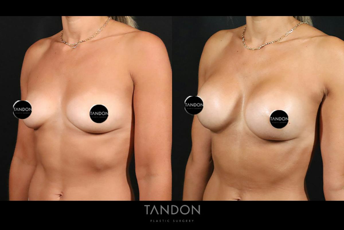 Preservé by Motiva Breast Augmentation Before & After Gallery - Patient 131882 - Image 4