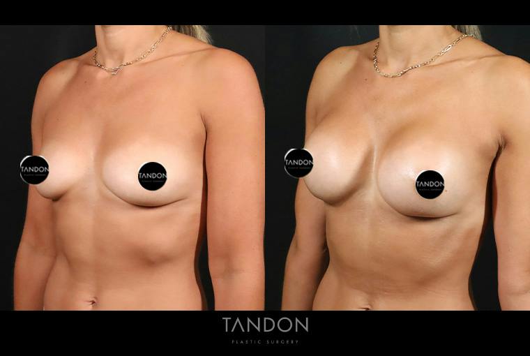 Preservé by Motiva Breast Augmentation Before & After Gallery - Patient 131882 - Image 4