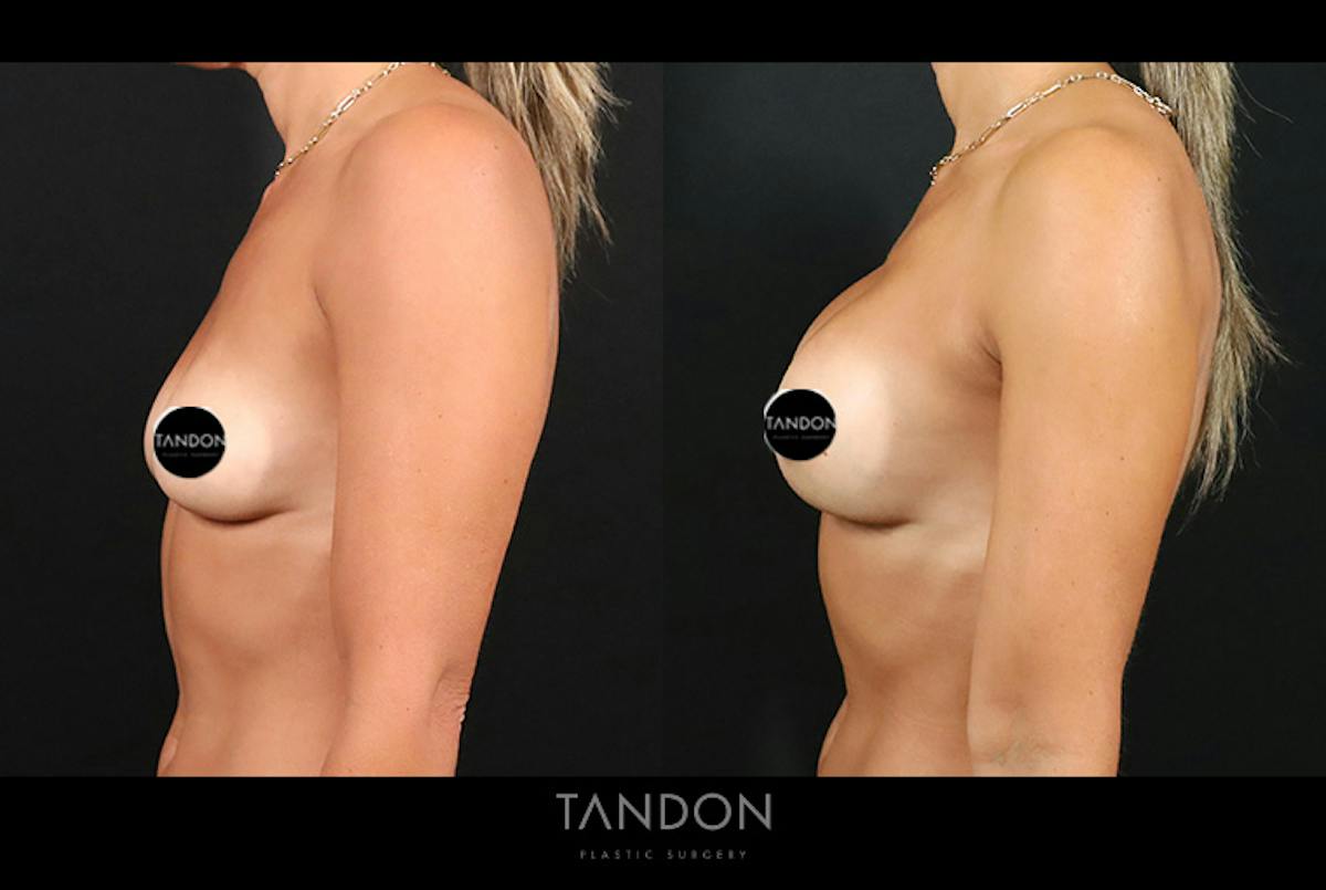 Preservé by Motiva Breast Augmentation Before & After Gallery - Patient 131882 - Image 5
