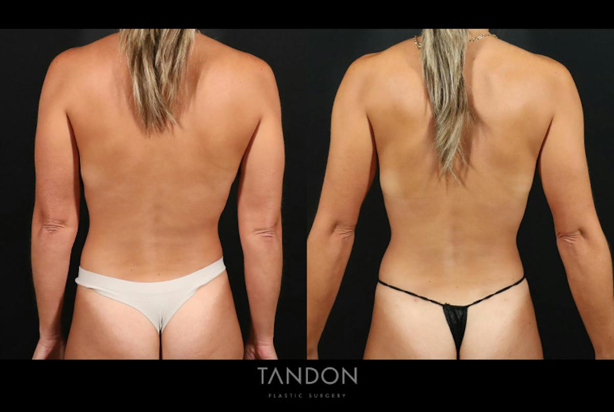 Preservé by Motiva Breast Augmentation Before & After Gallery - Patient 131882 - Image 6