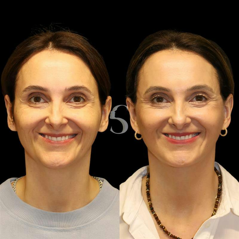 Deep Plane Facelift Before & After Gallery - Patient 267124 - Image 5