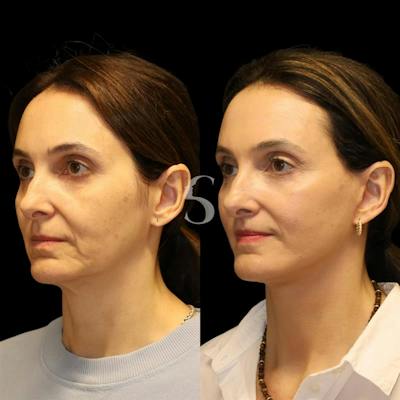 Deep Plane Facelift Before & After Gallery - Patient 267124 - Image 1