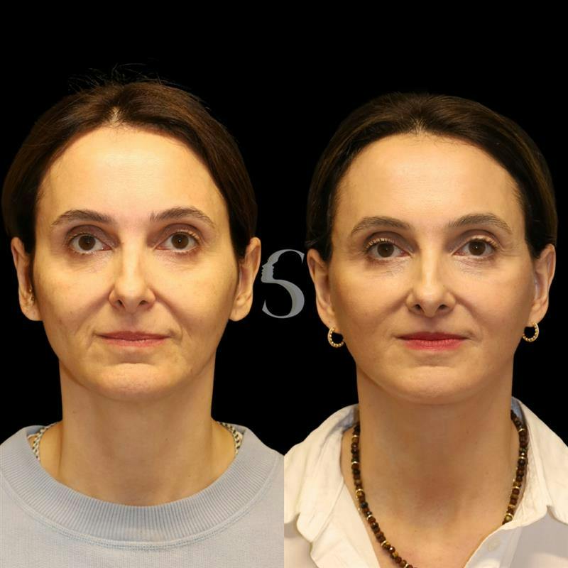 Deep Plane Facelift Before & After Gallery - Patient 267124 - Image 4