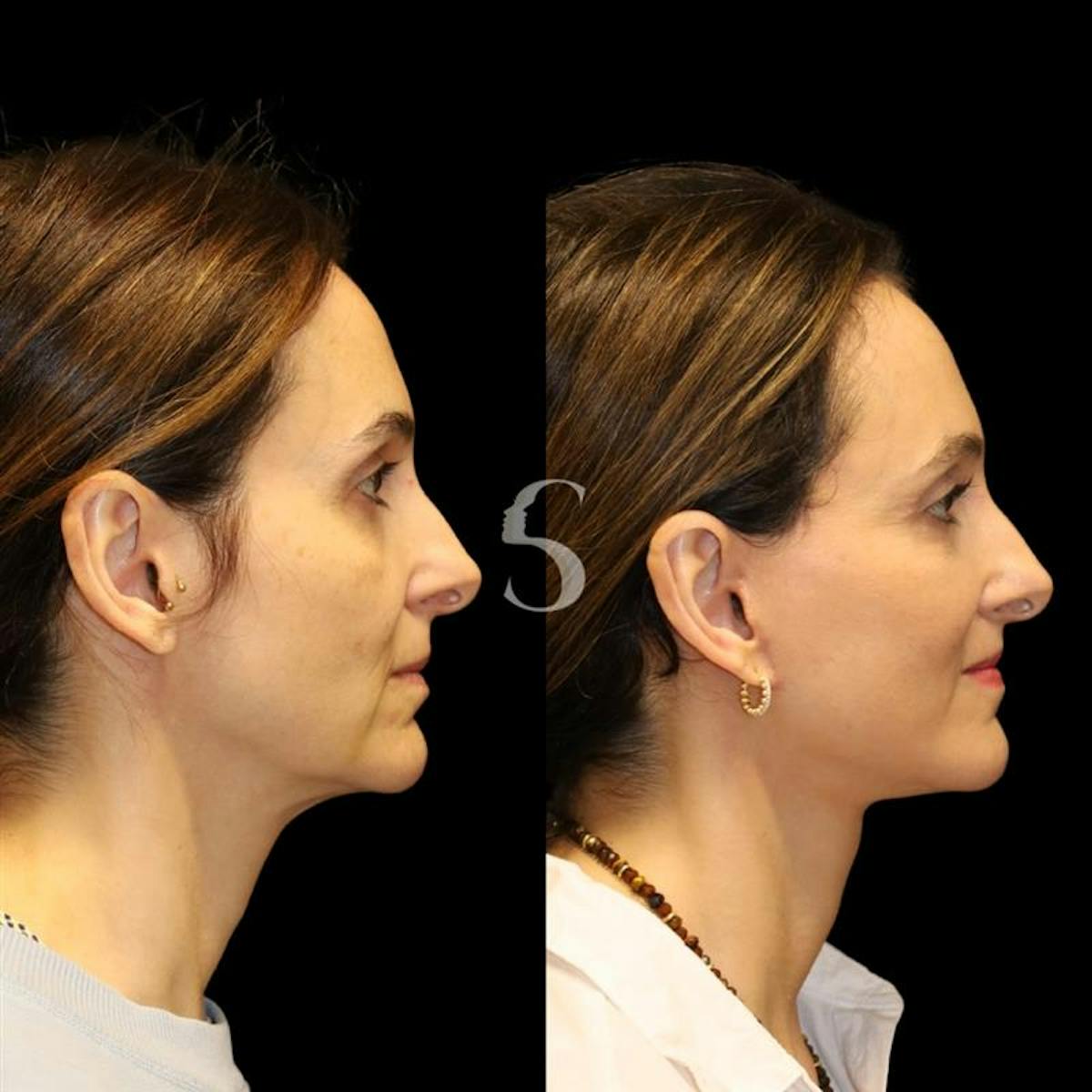 Deep Plane Facelift Before & After Gallery - Patient 267124 - Image 7