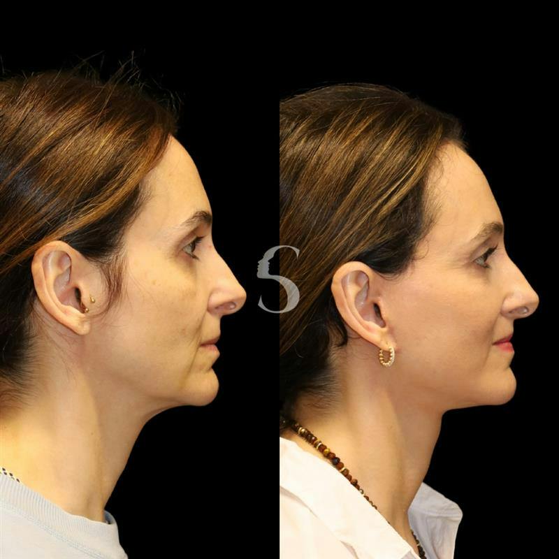 Deep Plane Facelift Before & After Gallery - Patient 267124 - Image 7