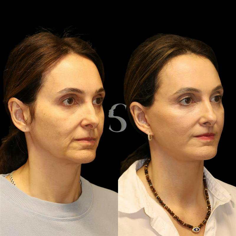 Deep Plane Facelift Before & After Gallery - Patient 267124 - Image 6