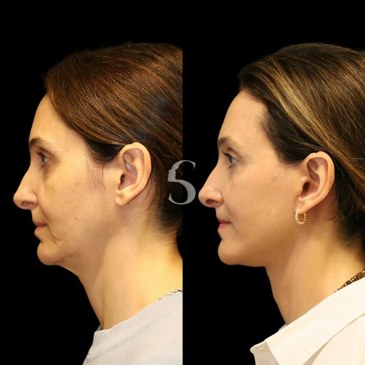 Deep Plane Facelift Before & After Gallery - Patient 267124 - Image 2