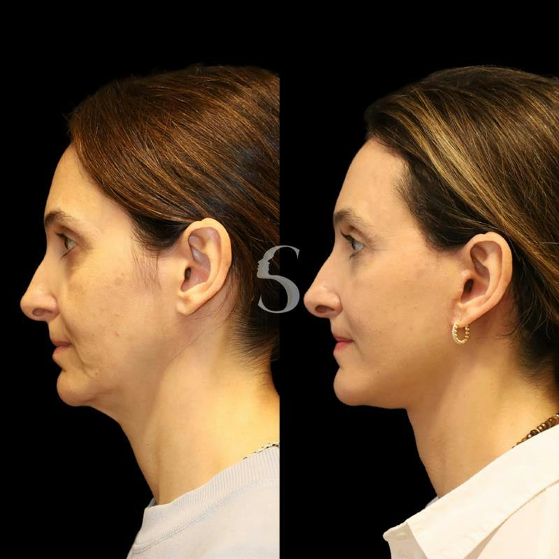 Deep Plane Facelift Before & After Gallery - Patient 267124 - Image 2