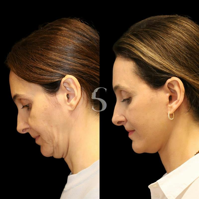 Deep Plane Facelift Before & After Gallery - Patient 267124 - Image 3