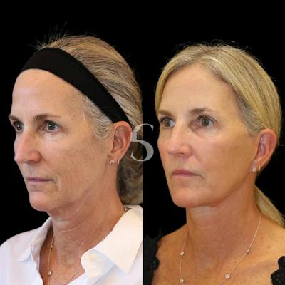 Deep Plane Facelift Before & After Gallery - Patient 138778 - Image 1