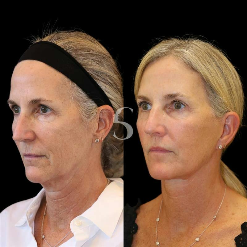 Lip Lift Before & After Gallery - Patient 340065 - Image 2