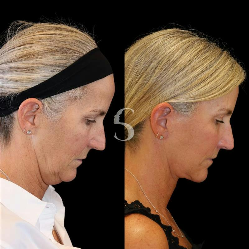 Lip Lift Before & After Gallery - Patient 340065 - Image 9