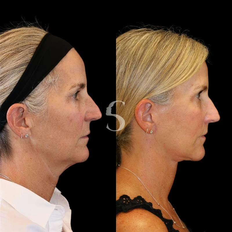 Lip Lift Before & After Gallery - Patient 340065 - Image 8