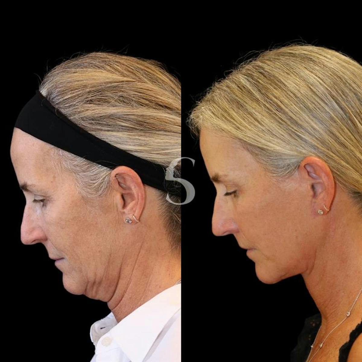 Lip Lift Before & After Gallery - Patient 340065 - Image 5