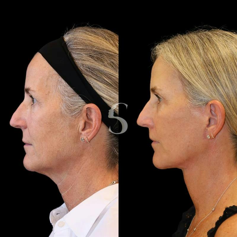 Lip Lift Before & After Gallery - Patient 340065 - Image 4