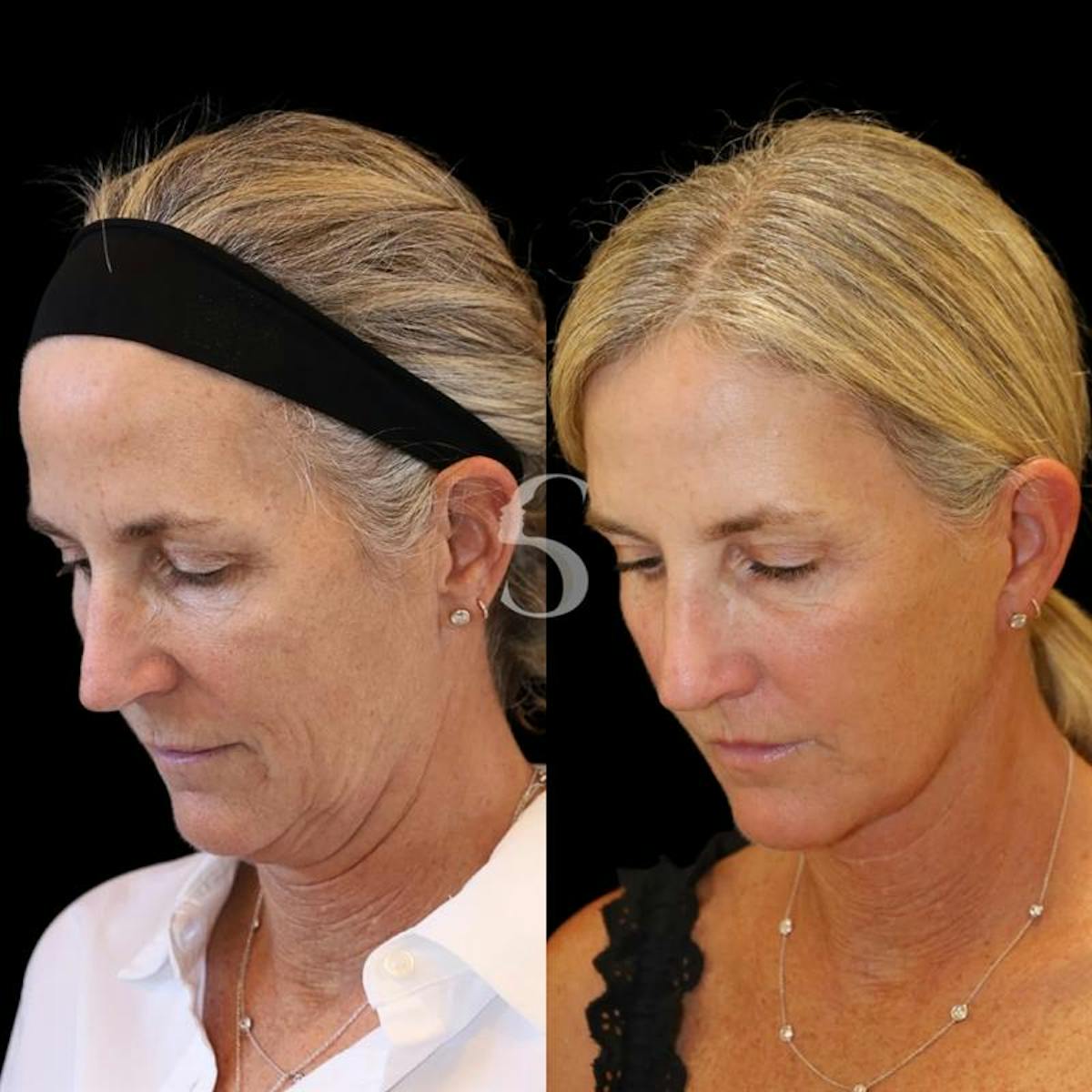 Lip Lift Before & After Gallery - Patient 340065 - Image 3