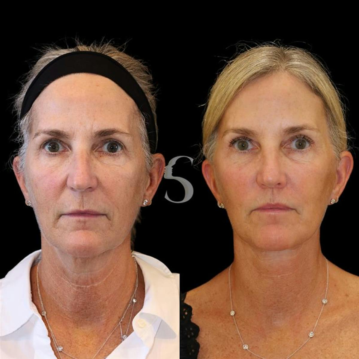 Lip Lift Before & After Gallery - Patient 340065 - Image 1