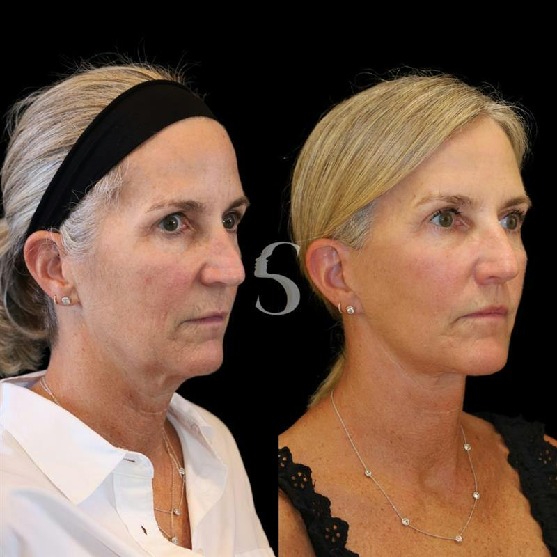 Lip Lift Before & After Gallery - Patient 340065 - Image 6
