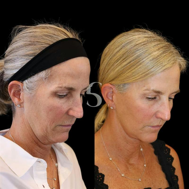Lip Lift Before & After Gallery - Patient 340065 - Image 7