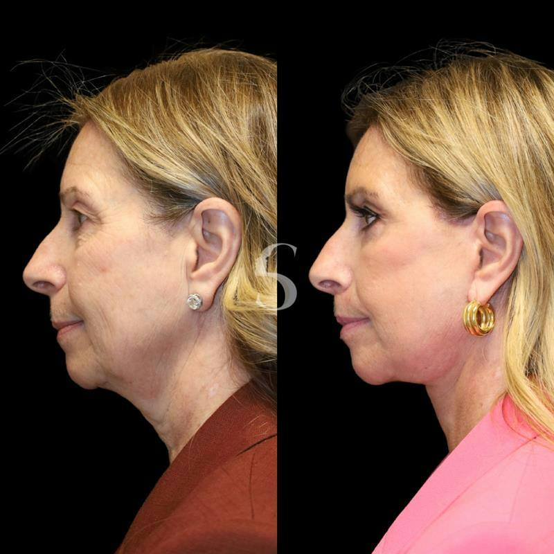 Blepharoplasty Before & After Gallery - Patient 915334 - Image 3