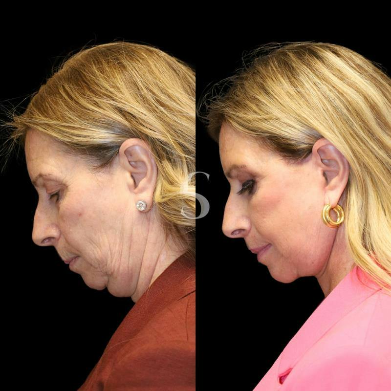 Blepharoplasty Before & After Gallery - Patient 915334 - Image 4
