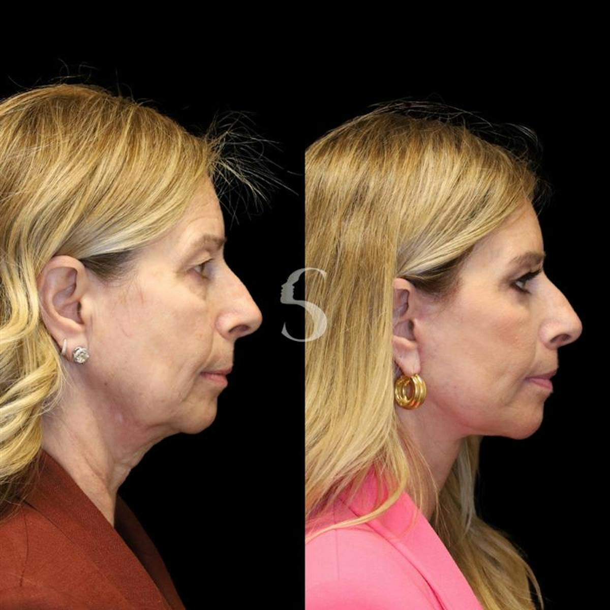 Blepharoplasty Before & After Gallery - Patient 915334 - Image 9