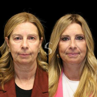 Blepharoplasty Before & After Gallery - Patient 915334 - Image 1