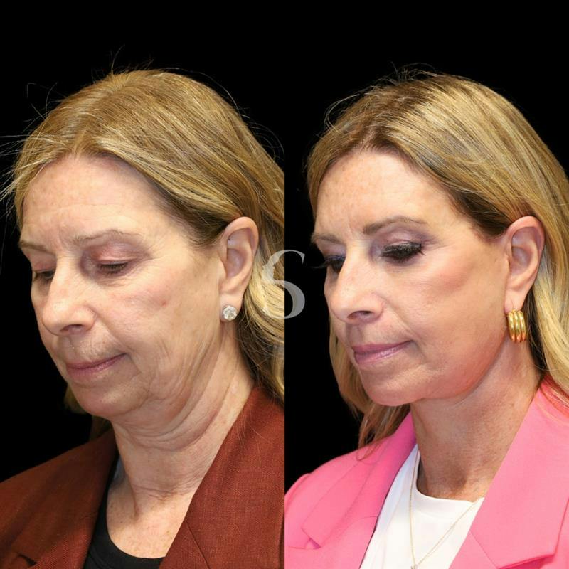 Blepharoplasty Before & After Gallery - Patient 915334 - Image 6