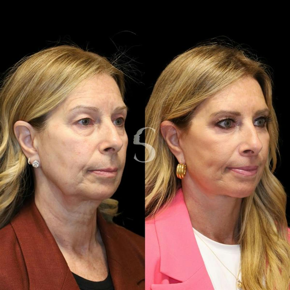 Blepharoplasty Before & After Gallery - Patient 915334 - Image 7