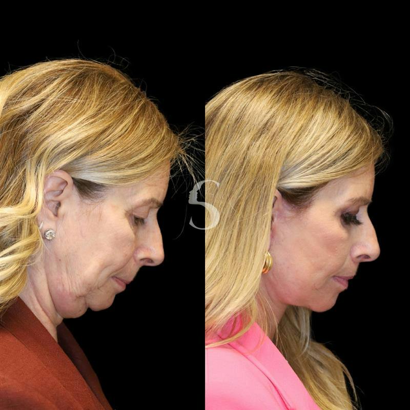 Blepharoplasty Before & After Gallery - Patient 915334 - Image 10