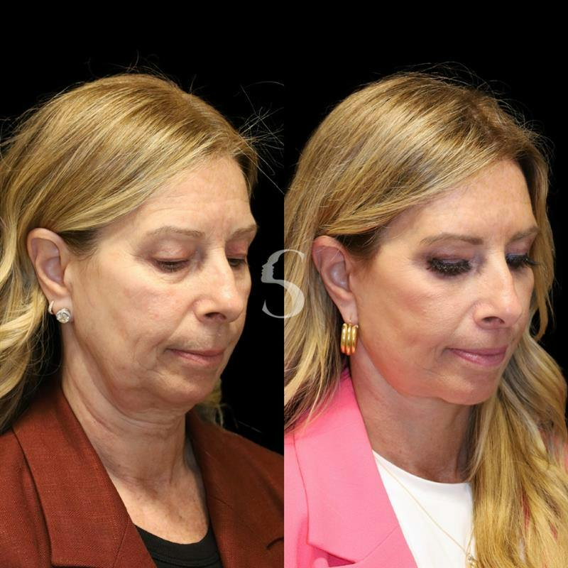 Blepharoplasty Before & After Gallery - Patient 915334 - Image 8