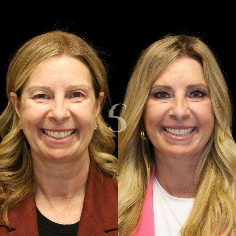 Blepharoplasty Before & After Gallery - Patient 915334 - Image 2