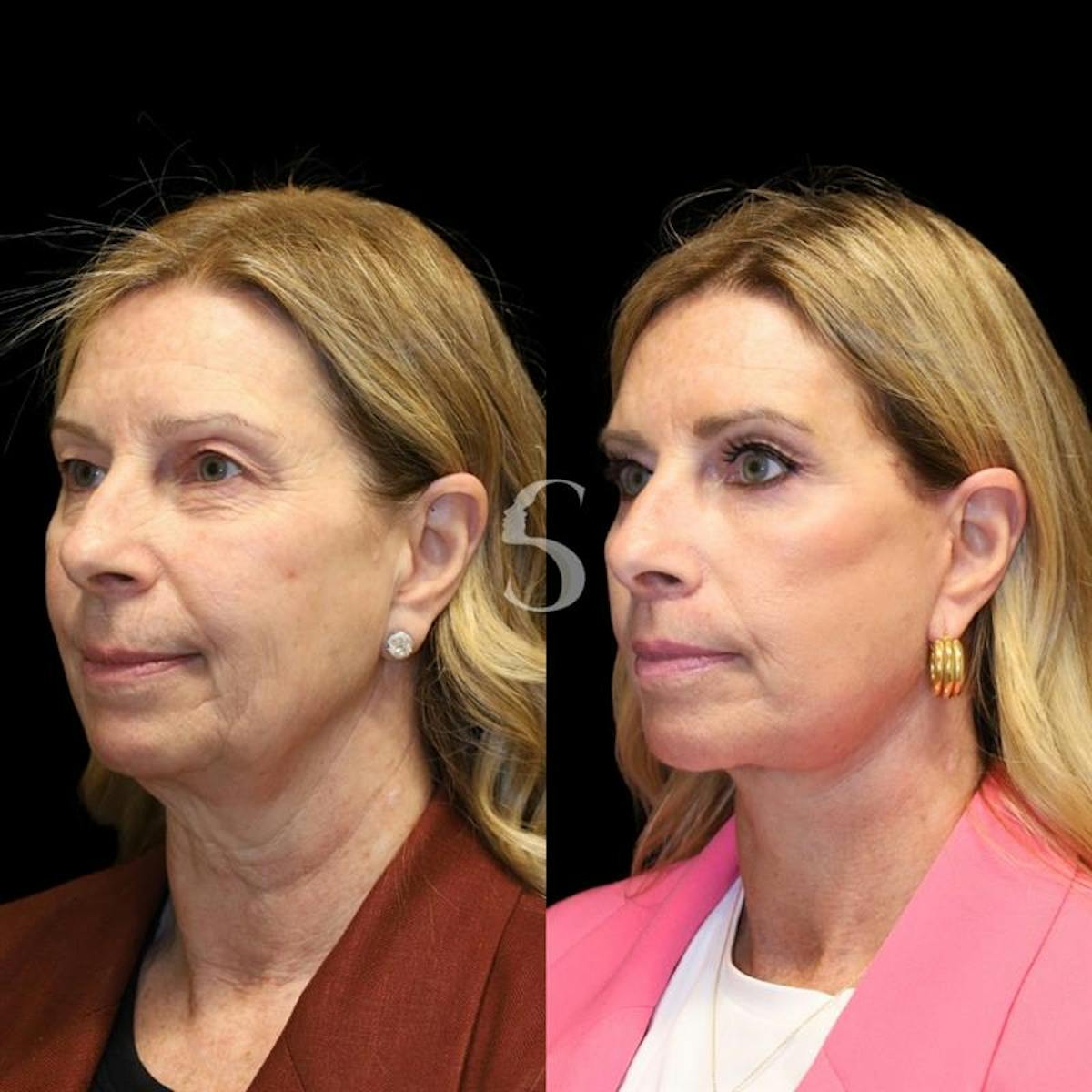 Blepharoplasty Before & After Gallery - Patient 915334 - Image 5