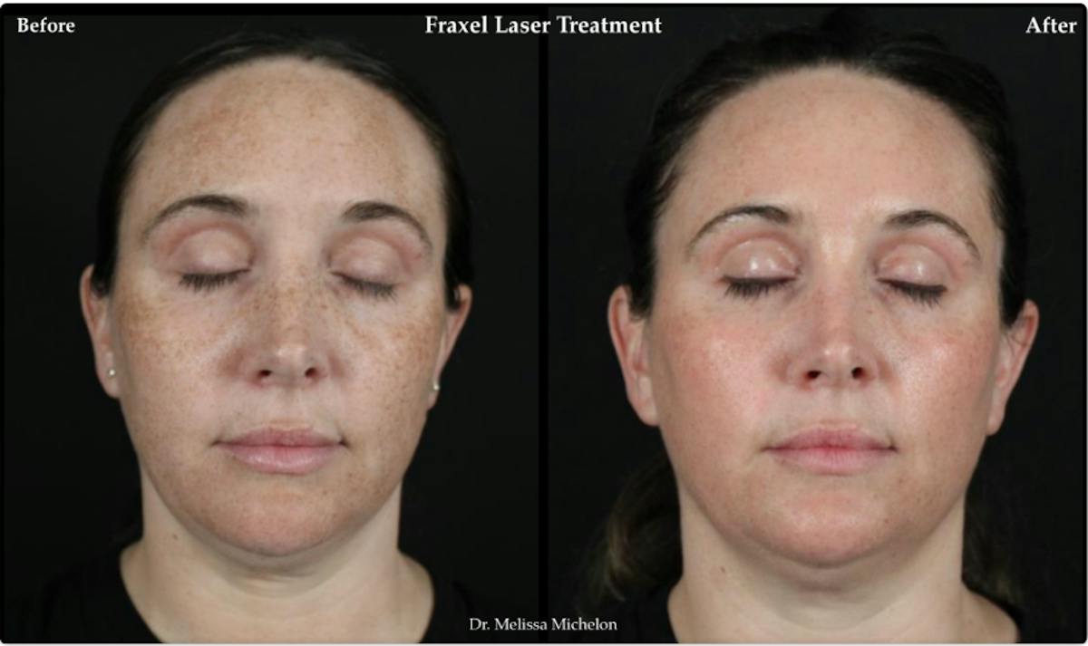 Clear & Brilliant (Fraxel) Before & After Gallery - Patient 125803 - Image 1