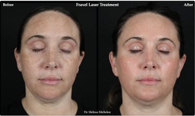Clear & Brilliant (Fraxel) Before & After Gallery - Patient 125803 - Image 1
